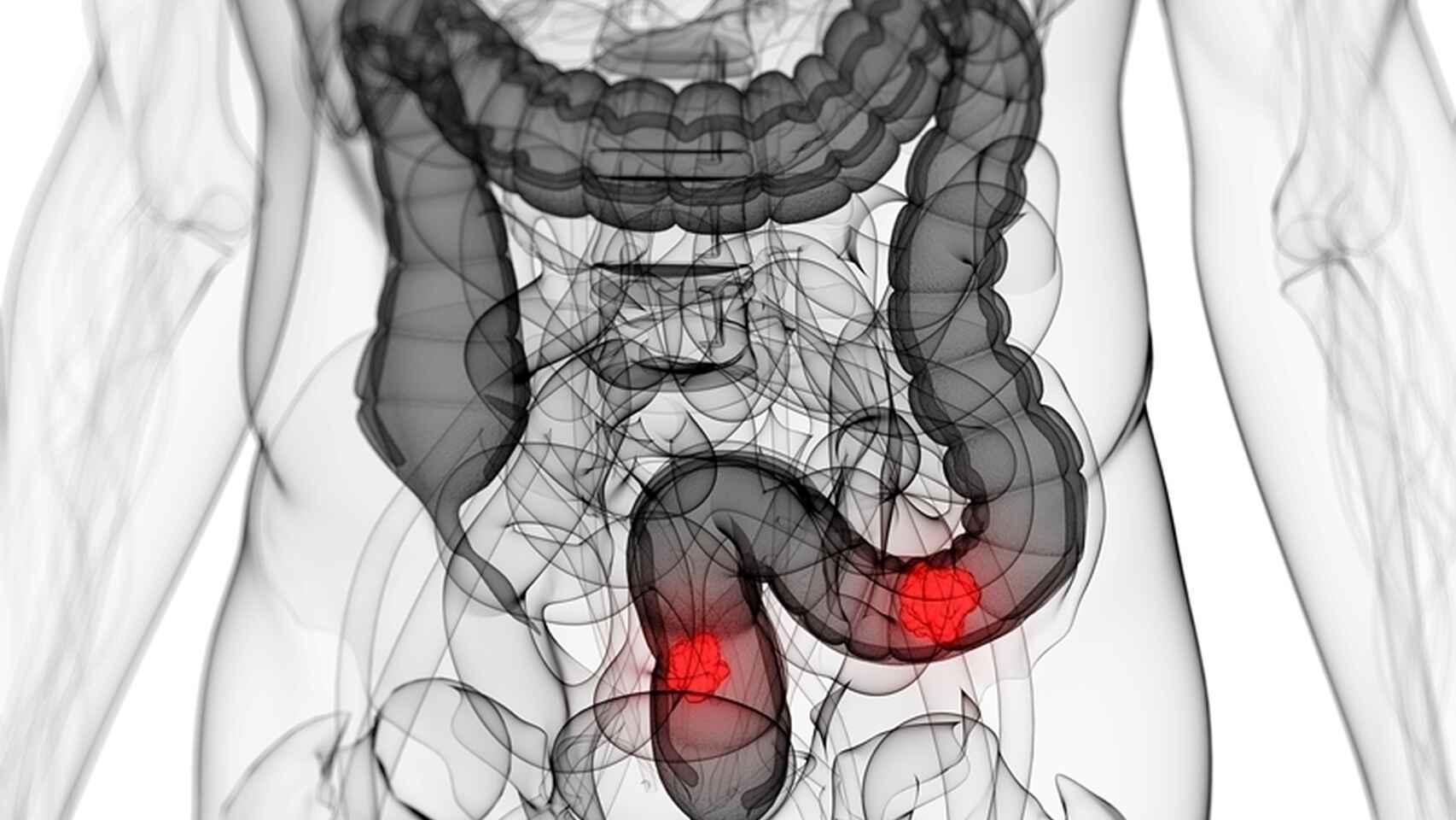 Representación gráfica de un intestino grueso.
