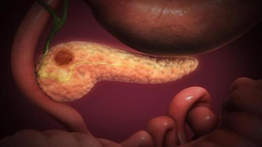 El cáncer de páncreas tiene una altísima tasa de letalidad.