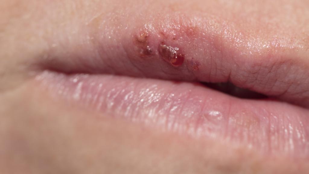 Un herpes labial.