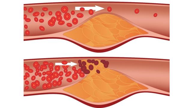 Placas de ateroma. EP.