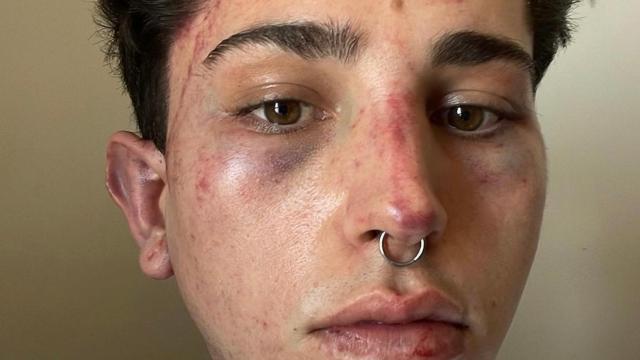 Ángel, el joven que ha denunciado la nueva agresión homófoba.