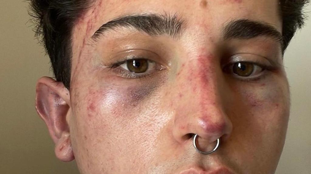 Ángel, el joven que ha denunciado la nueva agresión homófoba.