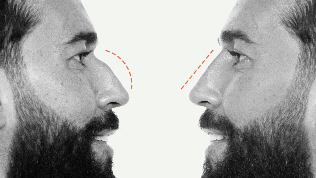 El windsurfista y marido de Anabel Pantoja, Omar Sánchez, antes de someterse a una rinoplastia líquida.