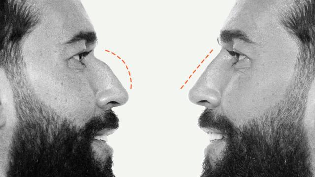 El windsurfista y marido de Anabel Pantoja, Omar Sánchez, antes de someterse a una rinoplastia líquida.