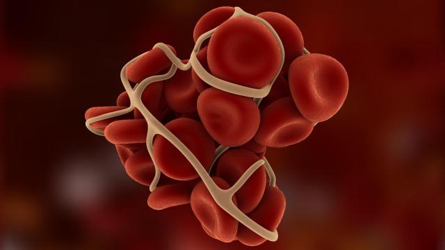 Representación de un trombo en la arteria.