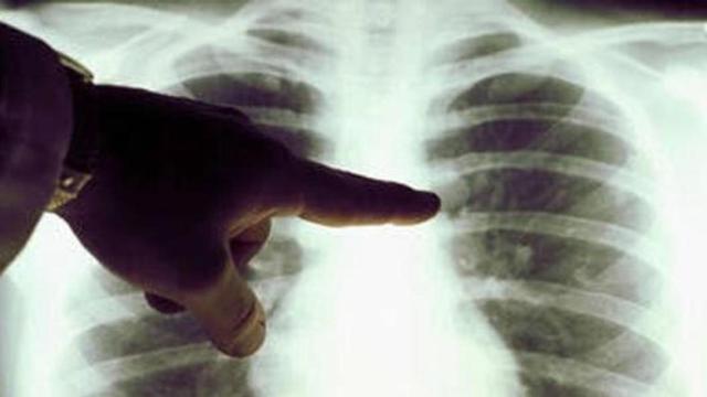 Imagen de archivo cáncer pulmón