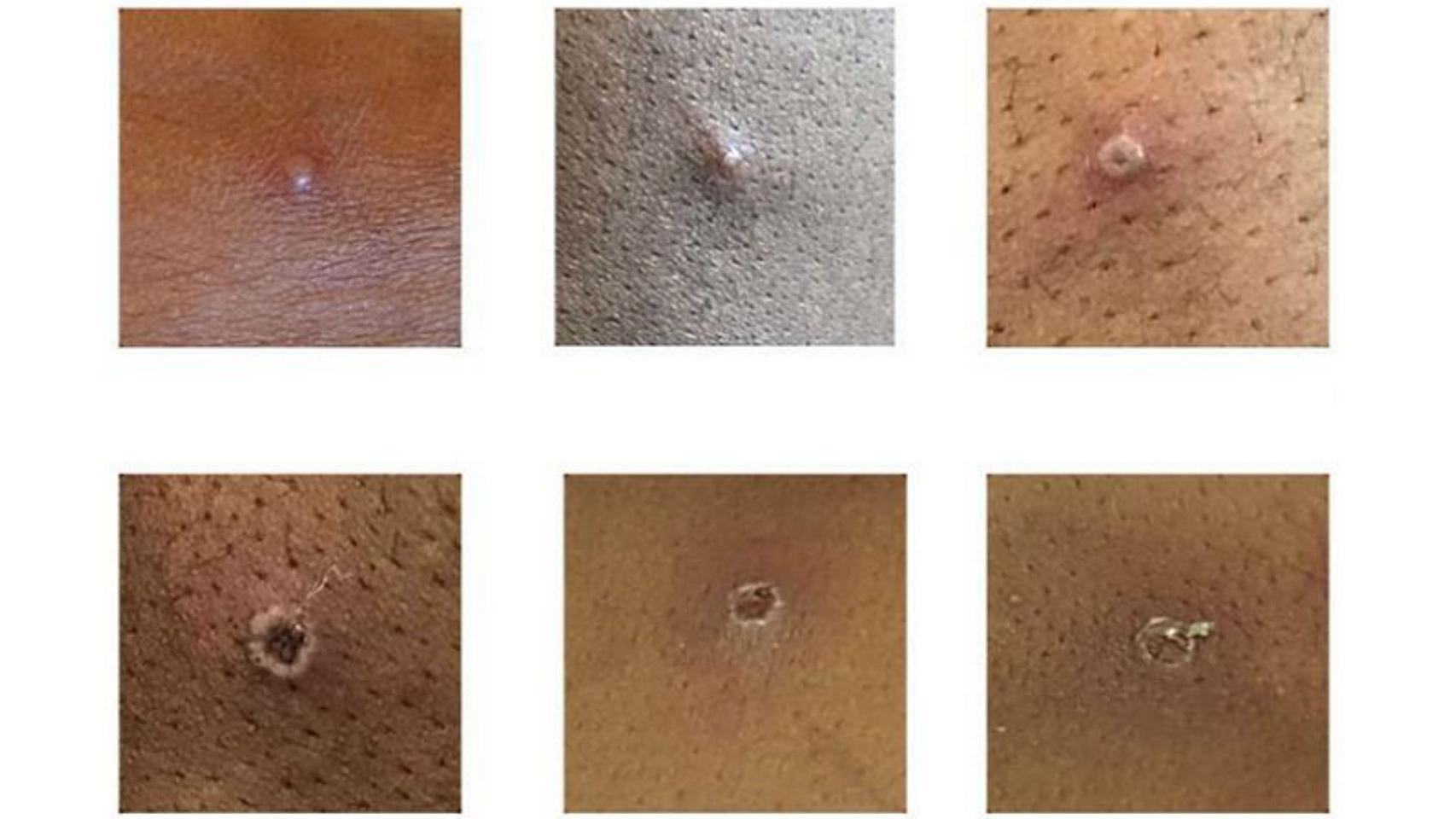 Ejemplos de lesiones cutáneas provocadas por la viruela del mono. UKHSA.