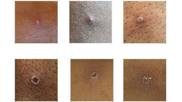 Ejemplos de lesiones cutáneas provocadas por la viruela del mono. UKHSA.