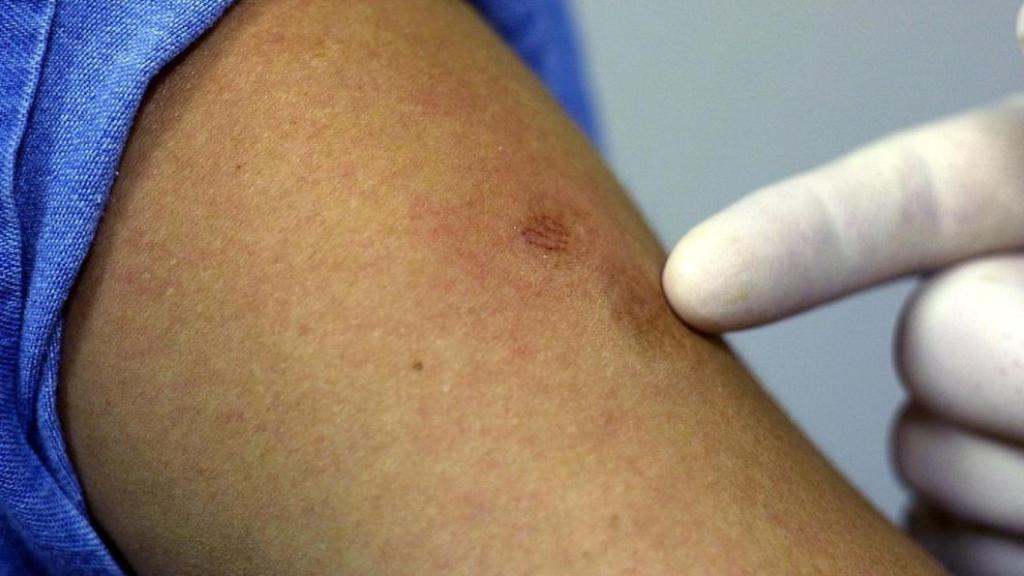 Europa recomienda vacunar a contactos estrechos de infectados con la viruela del mono