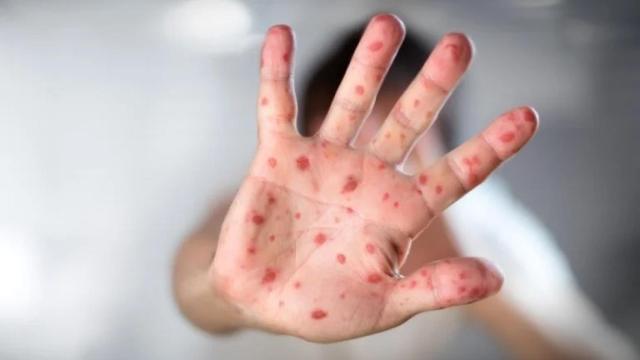 Lesiones cutáneas producidas por viruela del mono.