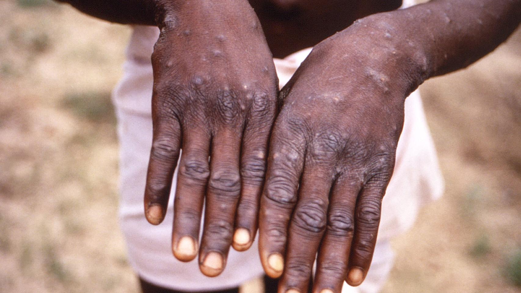 Un caso de viruela del mono detectado en 1996 en el Congo.