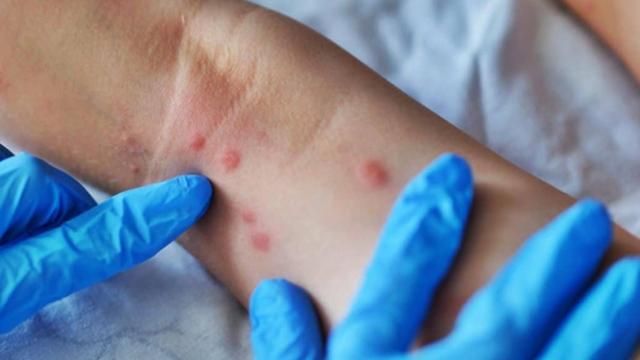 Llagas provocadas por la viruela del mono.