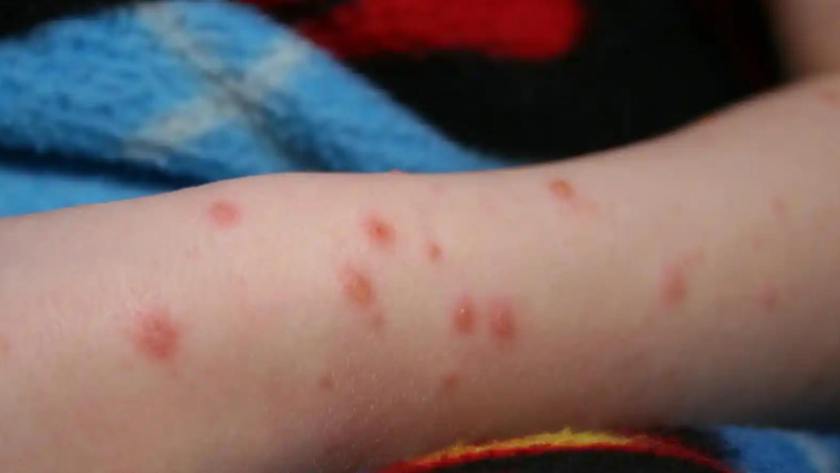 Un brazo con póstulas.