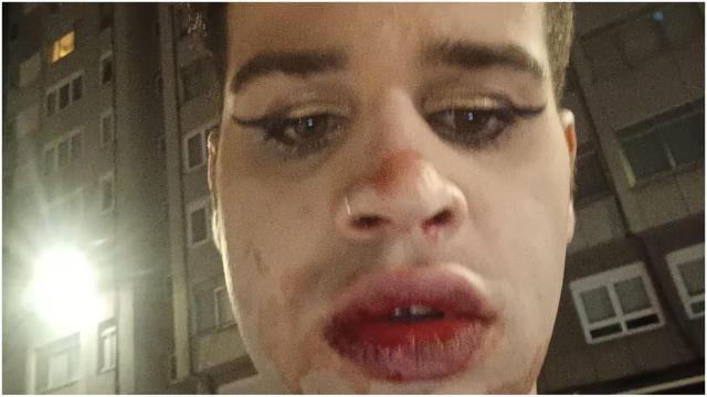 El joven agredido en las fiestas de Los Rosales de A Coruña.
