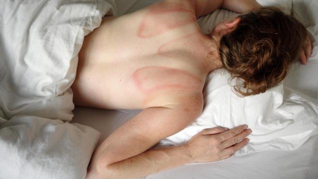 Enrojecimiento de la piel.