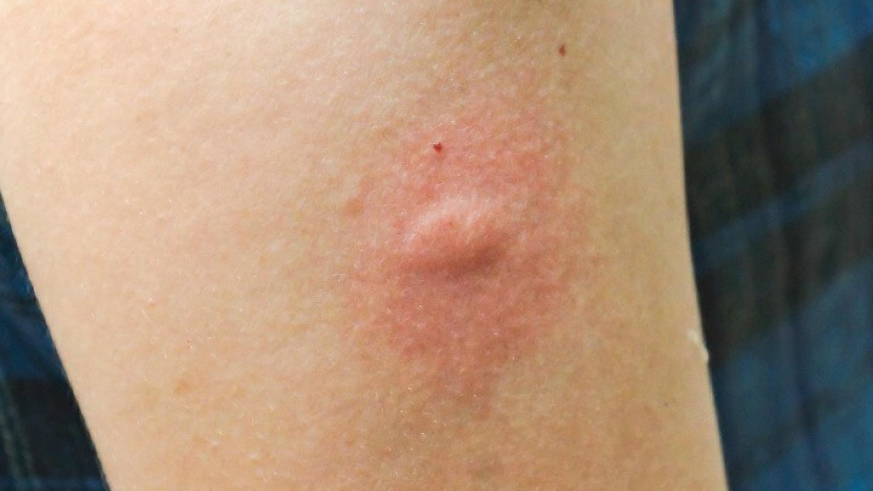 Picadura de mosquito.