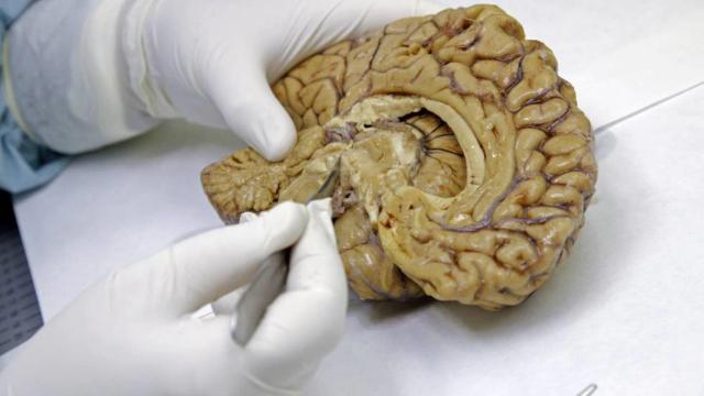 La Sociedad Española de Neurología ha alertado del incremento de casos en los últimos años.
