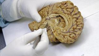 Golpe al alzhéimer: la novedosa y sencilla técnica para diagnosticarlo con años de antelación