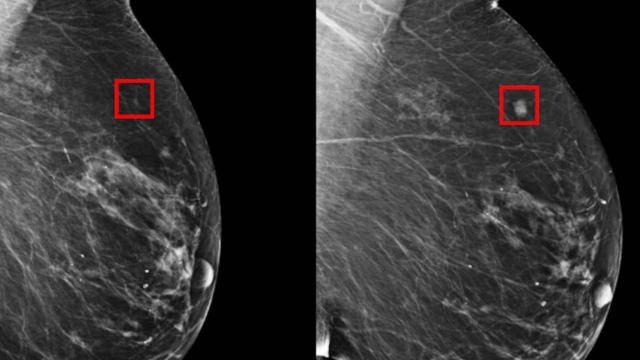 Imágenes de una mamografía.