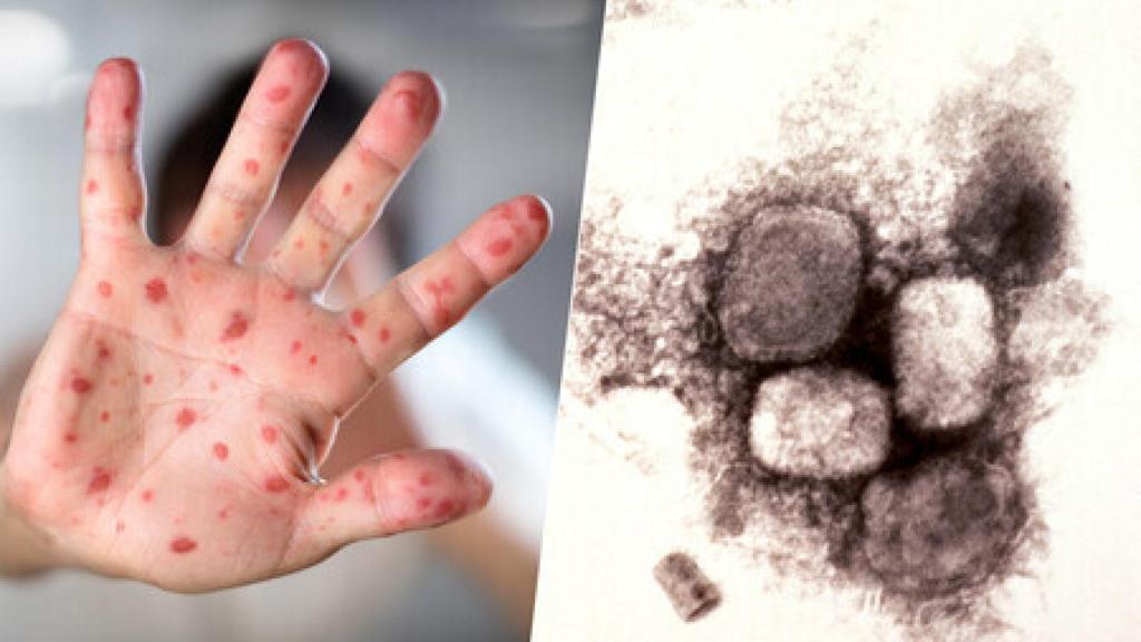 Efectos de la viruela del mono.