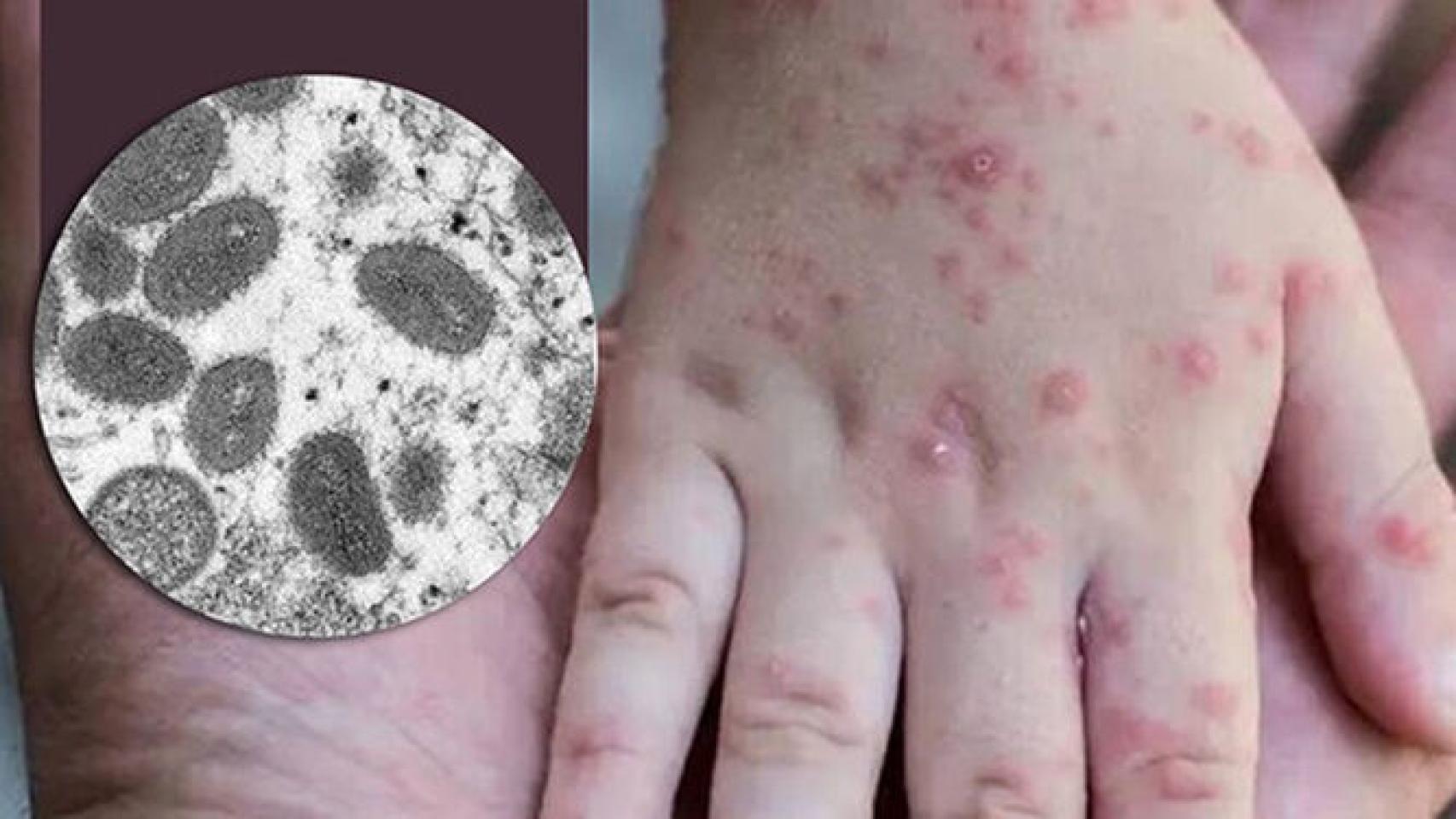 La mano de un niño con lesiones cutáneas de la viruela del mono.