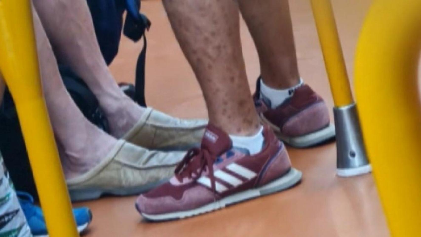 La imagen en la que se acusaba a un hombre con neurofibromatosis de tener viruela del mono.