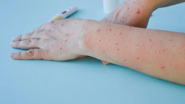 Imagen de archivo síntomas viruela del mono.