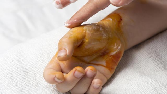 La mano de un niño con quemadura de segundo grado.