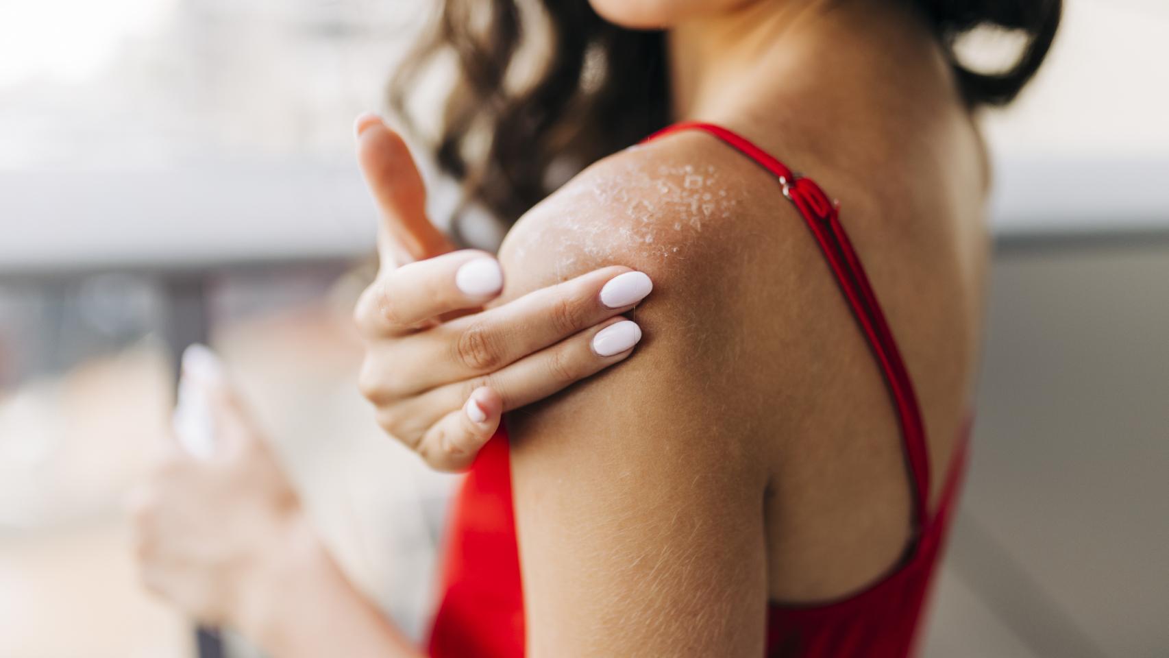 Una mujer se aplica crema hidratante en la piel quemada por el sol.