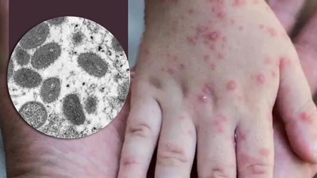 La mano de una persona afectada por la viruela del mono.