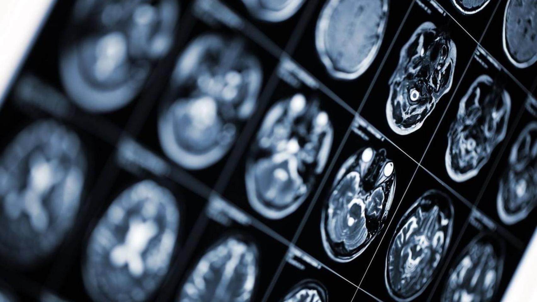 Prueba de imagen del cerebro de un paciente.