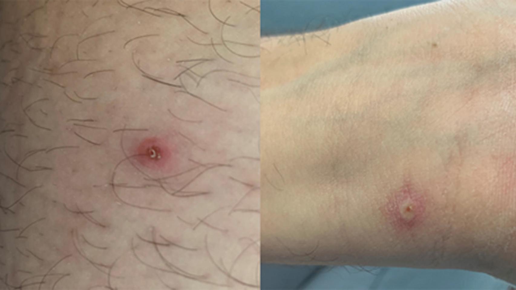 Las lesiones en la piel del paciente. JACC: Case Reports