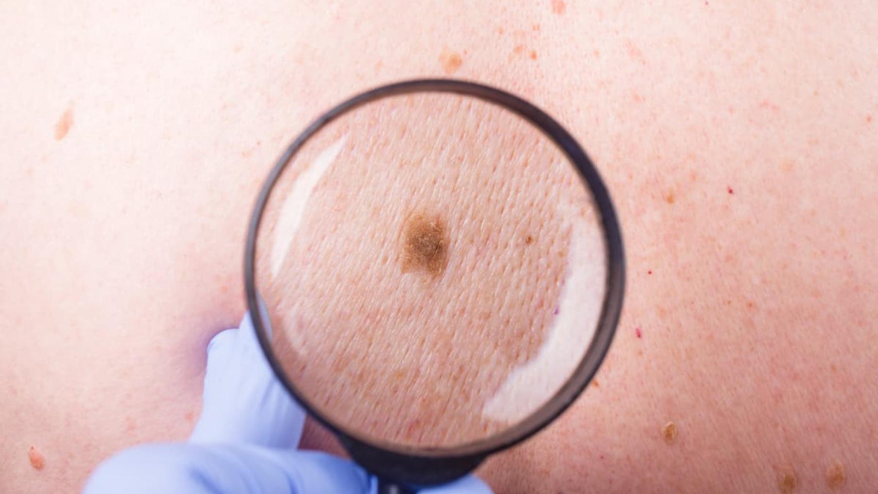 Un dermatólogo observa un lunar preocupante.