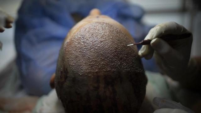 Un paciente, durante una intervención de trasplante capilar.