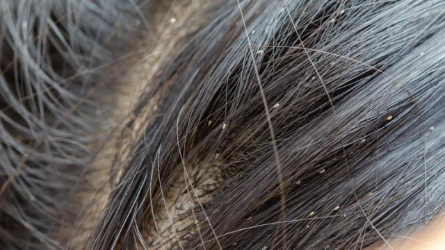 Los mejores trucos para prevenir los piojos.