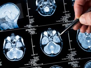 Golpe al cáncer cerebral más frecuente: frenan los ritmos noche-día que promueven su crecimiento