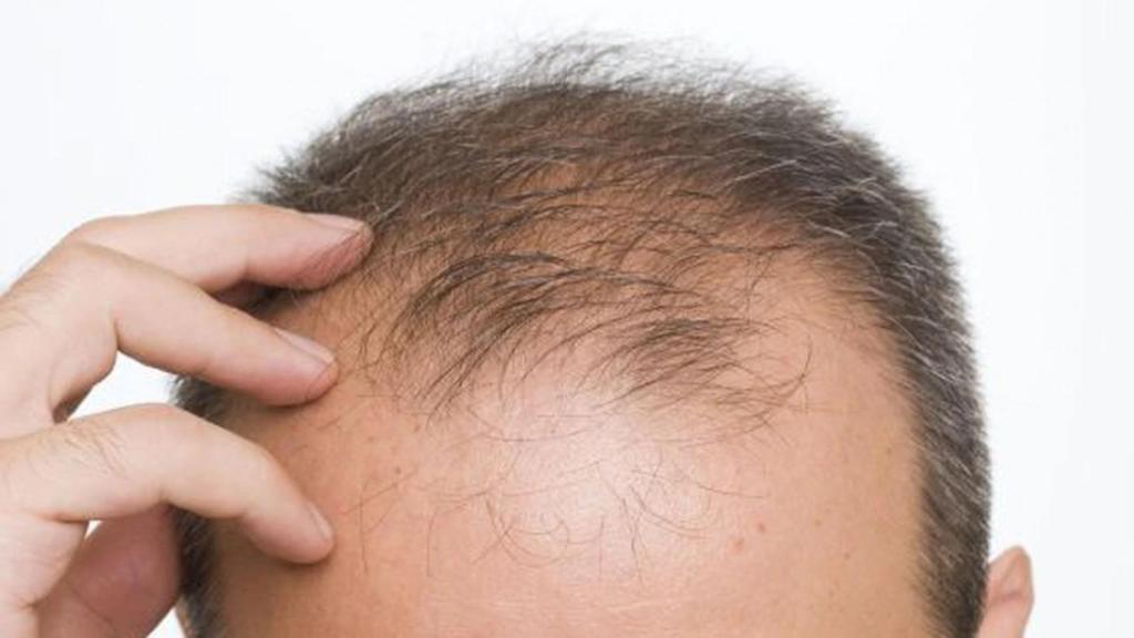 Un hombre con alopecia muestra su cabeza.