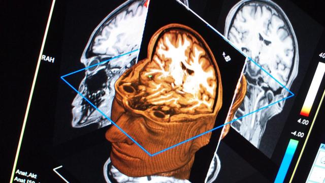 Montaje con varios tipos de escáner cerebral