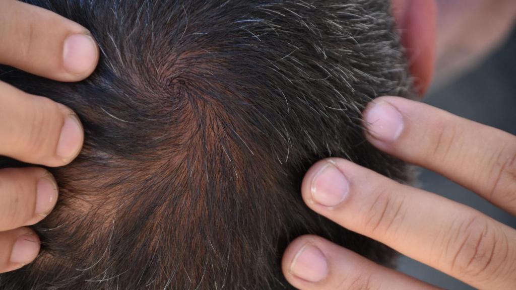 Un hombre muestra la poca densidad de pelo que le queda.