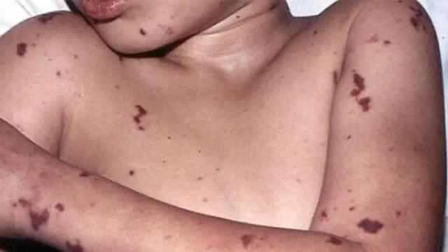 Imagen de archivo de una persona afectada por meningococos.