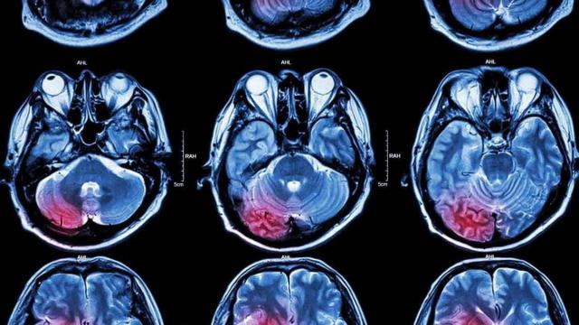 Imagen de un escáner cerebral.