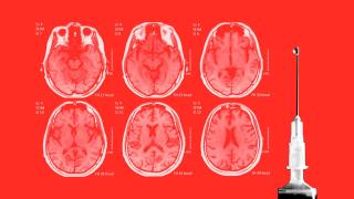 La esperanza del diagnóstico precoz del alzhéimer da un paso adelante con este hallazgo.