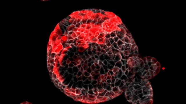 Organoide de cáncer colorrectal con células residuales responsables de la recaída (en rojo). Fuente: IRB Barcelona