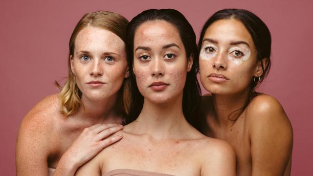 Los errores que cometes con tus marcas de acné (y cómo solucionarlos).