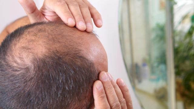 El minoxidil y la finasterida son los dos tratamientos contra la alopecia masculina más usados.
