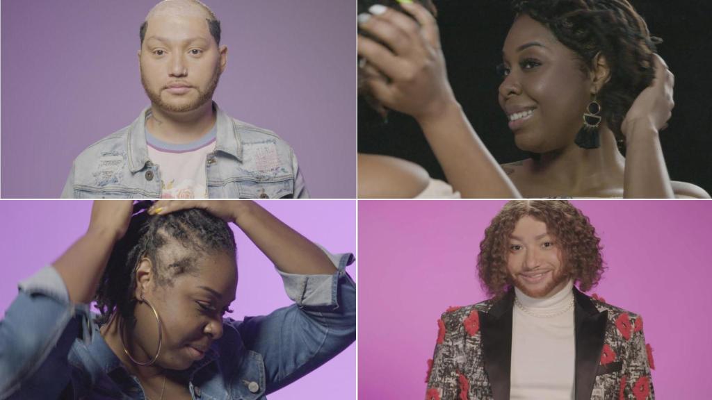 Al rescate de las calvos: el programa de DKISS que muestra lo que afecta la calvicie a la salud mental