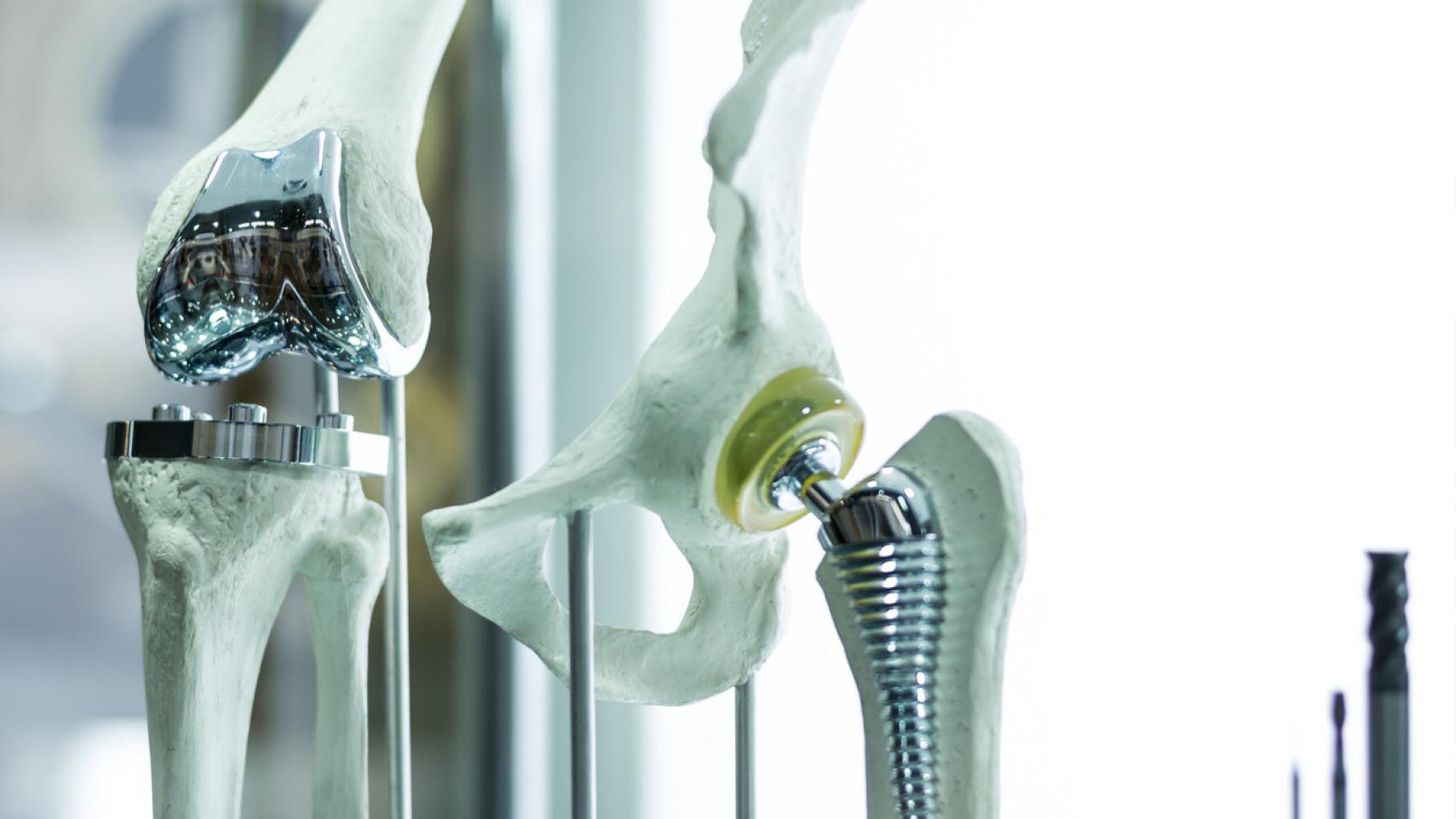 Prótesis a medida para el paciente: el futuro de la traumatología