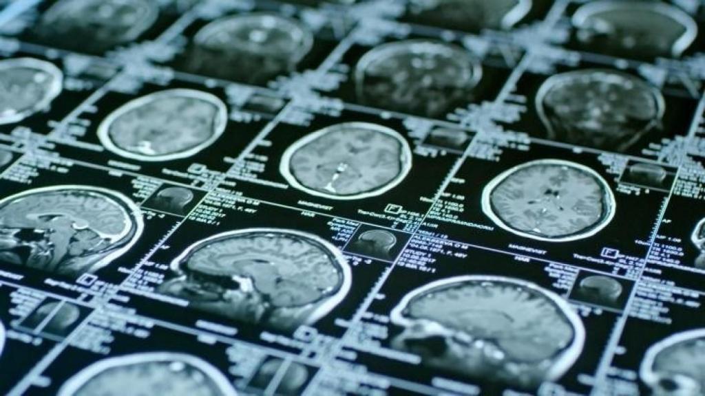 Imágenes de resonancia magnética de un cerebro. EP.