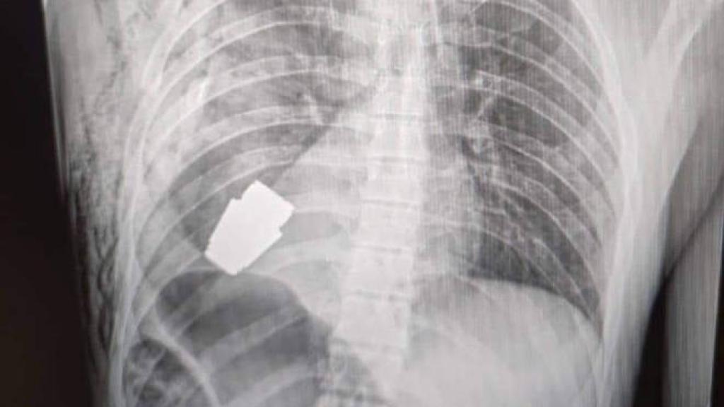 La radiografía muestra la granada alojada en el pecho del soldado ucraniano.