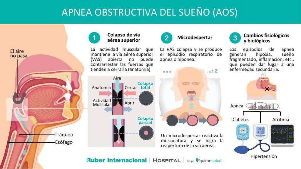 Una infografía sobre la apnea del sueño.
